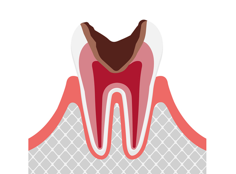 歯の神経の虫歯（C3）